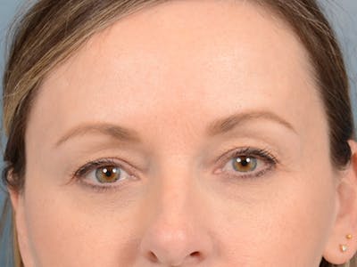 Eyelid Lift Before & After Gallery - Patient 123090407 - Image 1
