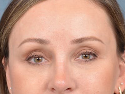 Eyelid Lift Before & After Gallery - Patient 123090407 - Image 2