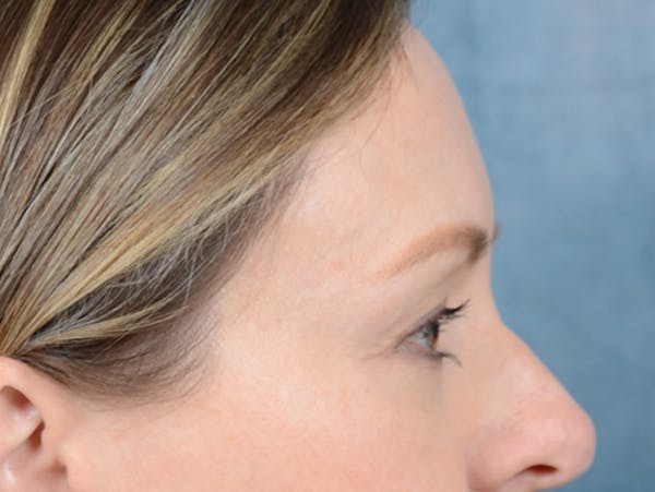 Eyelid Lift Before & After Gallery - Patient 123090407 - Image 5
