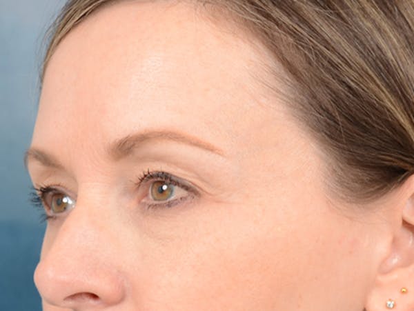 Eyelid Lift Before & After Gallery - Patient 123090407 - Image 7