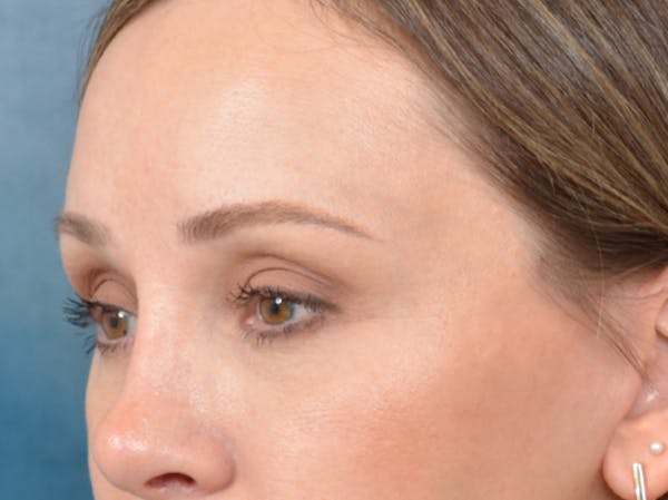 Eyelid Lift Before & After Gallery - Patient 123090407 - Image 8