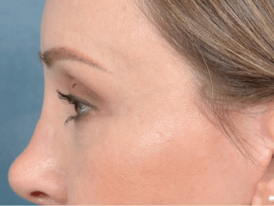 Eyelid Lift Before & After Gallery - Patient 123090407 - Image 10