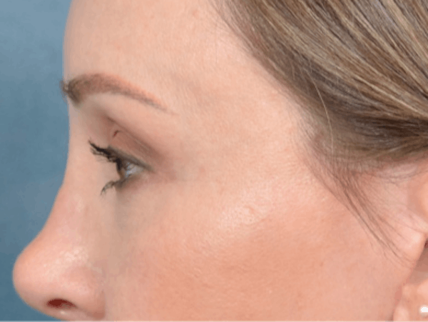 Eyelid Lift Before & After Gallery - Patient 123090407 - Image 10