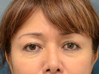 Eyelid Lift Before & After Gallery - Patient 123718986 - Image 1