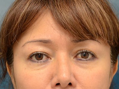 Eyelid Lift Before & After Gallery - Patient 123718986 - Image 1