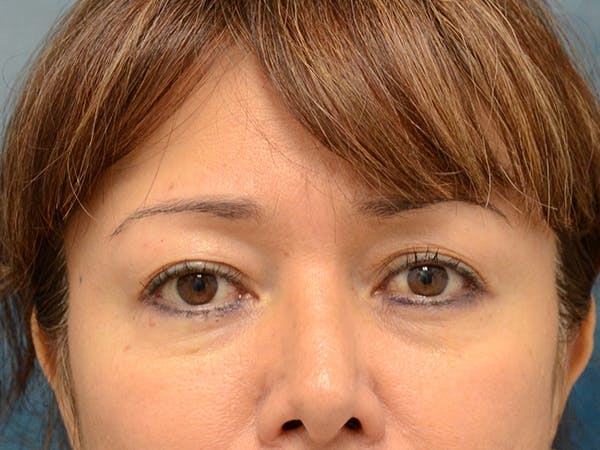 Eyelid Lift Before & After Gallery - Patient 123718986 - Image 1