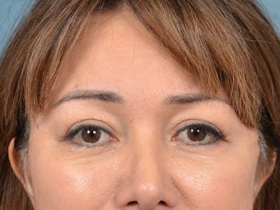 Eyelid Lift Before & After Gallery - Patient 123718986 - Image 2
