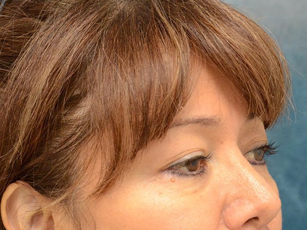 Eyelid Lift Before & After Gallery - Patient 123718986 - Image 3