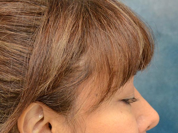 Eyelid Lift Before & After Gallery - Patient 123718986 - Image 5