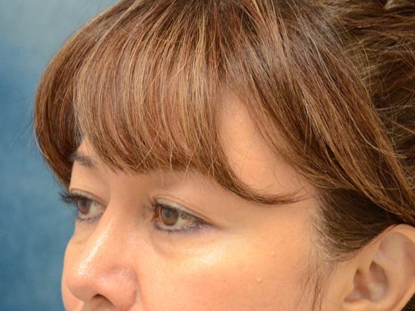 Eyelid Lift Before & After Gallery - Patient 123718986 - Image 7