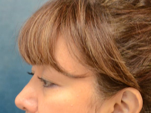 Eyelid Lift Before & After Gallery - Patient 123718986 - Image 9