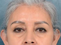 Eyelid Lift Before & After Gallery - Patient 143507941 - Image 1