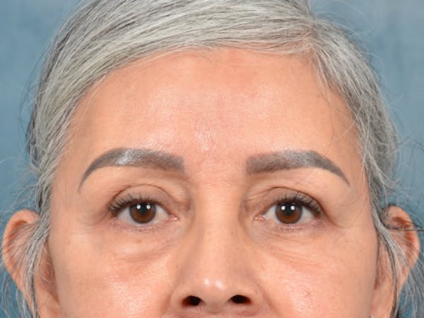 Eyelid Lift Before & After Gallery - Patient 143507941 - Image 2