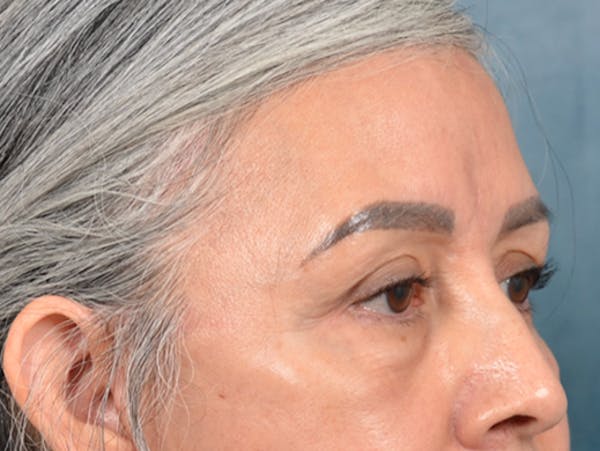 Eyelid Lift Before & After Gallery - Patient 143507941 - Image 4