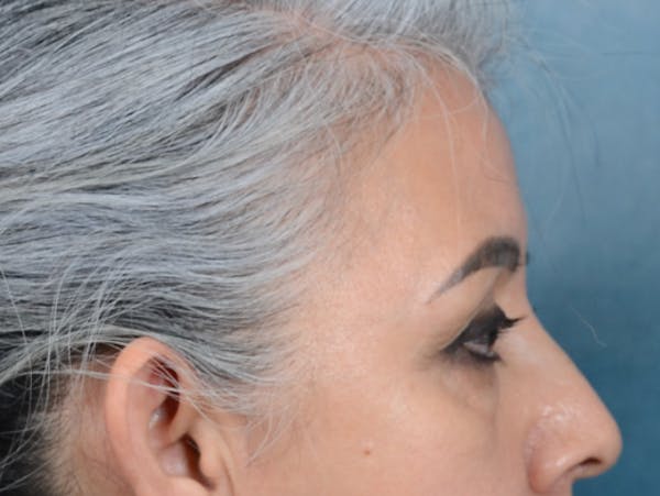 Eyelid Lift Before & After Gallery - Patient 143507941 - Image 5