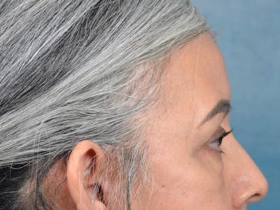 Eyelid Lift Before & After Gallery - Patient 143507941 - Image 6