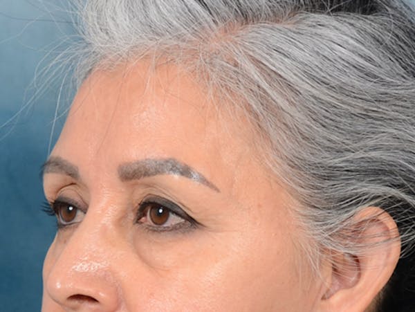 Eyelid Lift Before & After Gallery - Patient 143507941 - Image 7