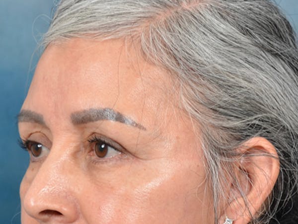 Eyelid Lift Before & After Gallery - Patient 143507941 - Image 8