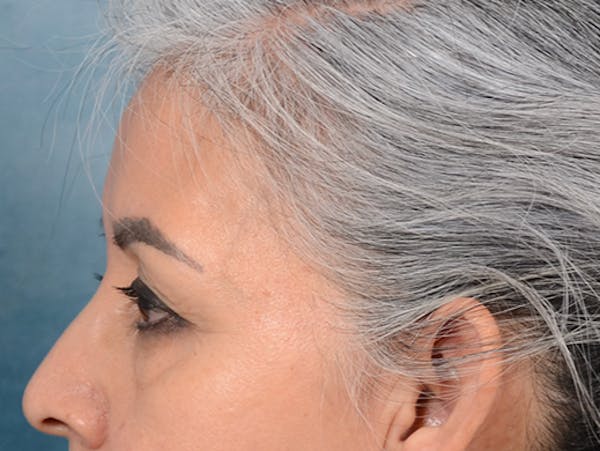 Eyelid Lift Before & After Gallery - Patient 143507941 - Image 9