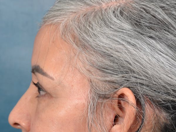 Eyelid Lift Before & After Gallery - Patient 143507941 - Image 10
