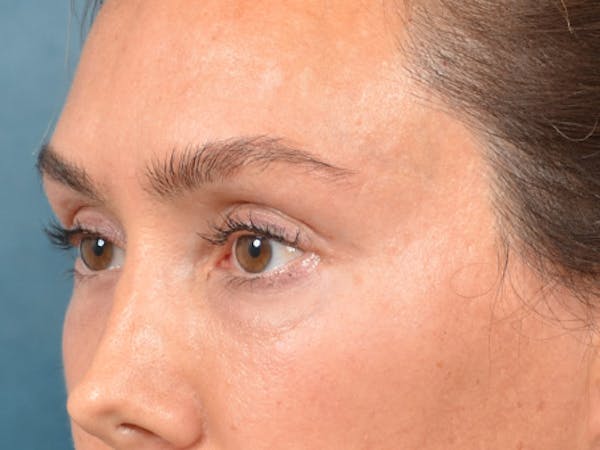 Eyelid Lift Before & After Gallery - Patient 146208591 - Image 3