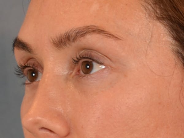 Eyelid Lift Before & After Gallery - Patient 146208591 - Image 4