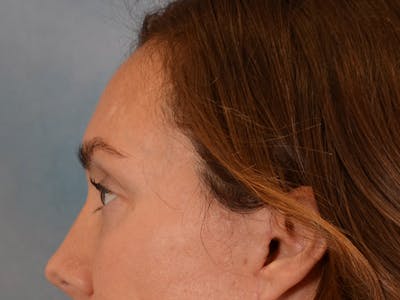 Eyelid Lift Before & After Gallery - Patient 146208591 - Image 6