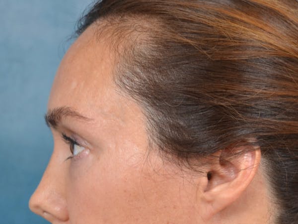 Eyelid Lift Before & After Gallery - Patient 146208591 - Image 5