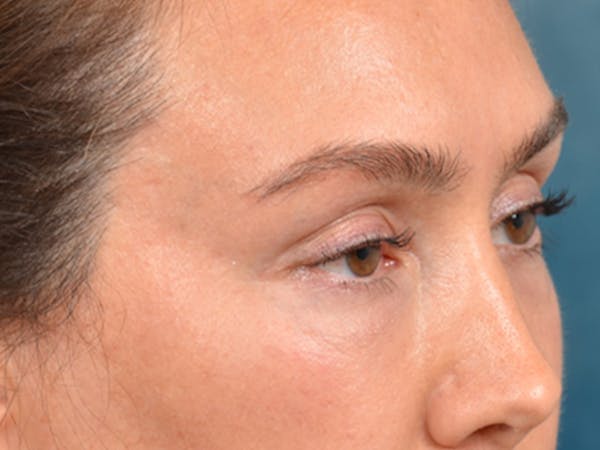 Eyelid Lift Before & After Gallery - Patient 146208591 - Image 7