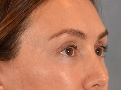 Eyelid Lift Before & After Gallery - Patient 146208591 - Image 8
