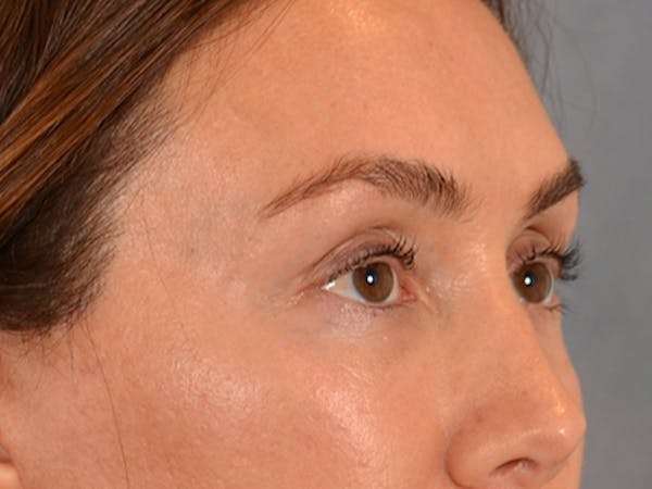 Eyelid Lift Before & After Gallery - Patient 146208591 - Image 8