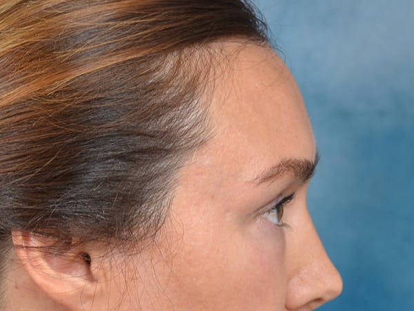 Eyelid Lift Before & After Gallery - Patient 146208591 - Image 9