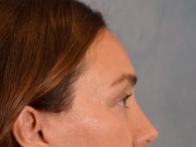 Eyelid Lift Before & After Gallery - Patient 146208591 - Image 10