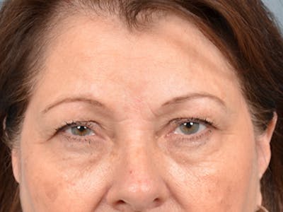 Eyelid Lift Before & After Gallery - Patient 146208685 - Image 1