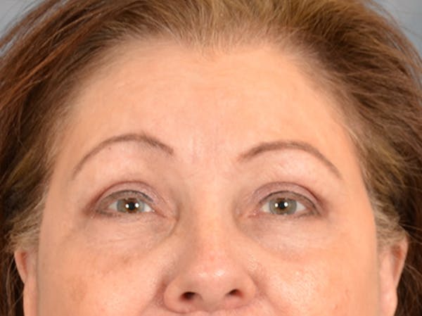Eyelid Lift Before & After Gallery - Patient 146208685 - Image 2