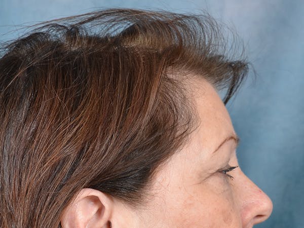 Eyelid Lift Before & After Gallery - Patient 146208685 - Image 5
