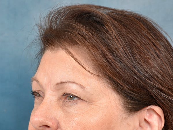 Eyelid Lift Before & After Gallery - Patient 146208685 - Image 7