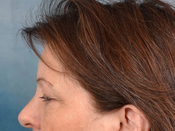 Eyelid Lift Before & After Gallery - Patient 146208685 - Image 9