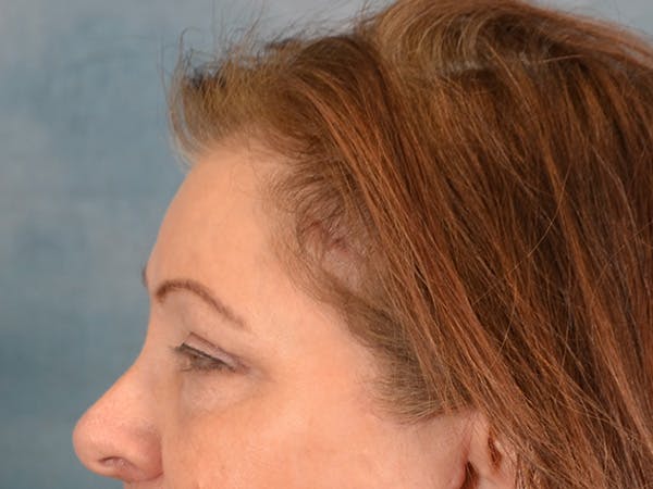 Eyelid Lift Before & After Gallery - Patient 146208685 - Image 10