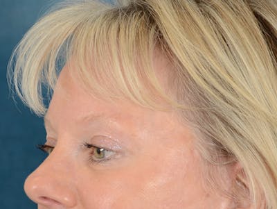 Eyelid Lift Before & After Gallery - Patient 146899107 - Image 4