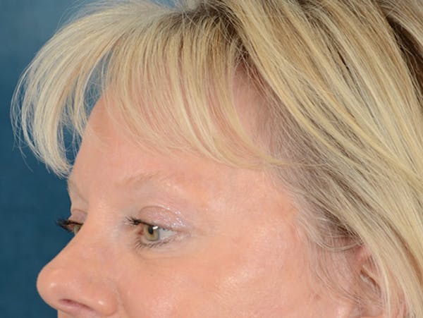 Eyelid Lift Before & After Gallery - Patient 146899107 - Image 4