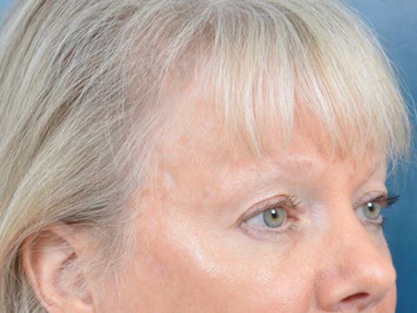 Eyelid Lift Before & After Gallery - Patient 146899107 - Image 5