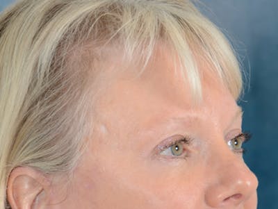 Eyelid Lift Before & After Gallery - Patient 146899107 - Image 6