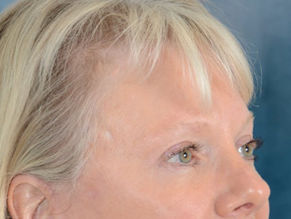 Eyelid Lift Before & After Gallery - Patient 146899107 - Image 6