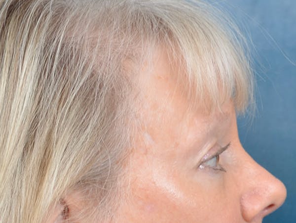 Eyelid Lift Before & After Gallery - Patient 146899107 - Image 7