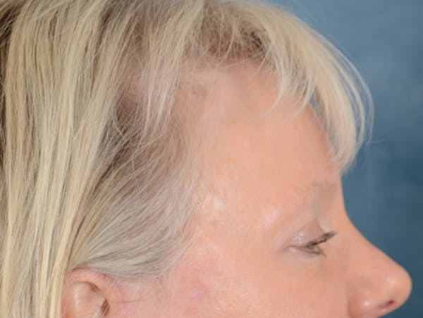Eyelid Lift Before & After Gallery - Patient 146899107 - Image 8