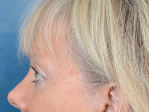 Eyelid Lift Before & After Gallery - Patient 146899107 - Image 9