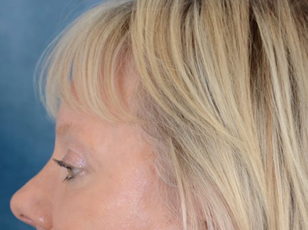 Eyelid Lift Before & After Gallery - Patient 146899107 - Image 10