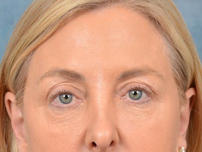 Eyelid Lift Before & After Gallery - Patient 146899125 - Image 1