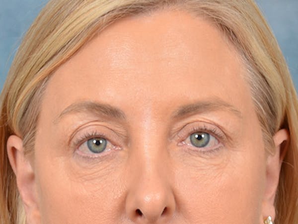 Eyelid Lift Before & After Gallery - Patient 146899125 - Image 1